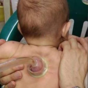 حجامت برای درمان زردی نوزاد